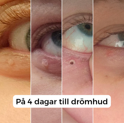 DermClear Set – Inga fler hudflikar